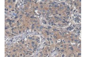 DAB staining on IHC-P; Samples: Human Prostate cancer Tissue (SAA antibody  (AA 19-122))