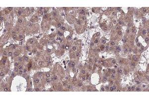 ABIN6277524 at 1/100 staining Human liver cancer tissue by IHC-P. (SLC4A4 antibody  (C-Term))