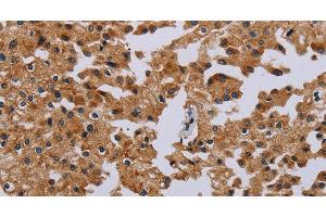 Immunohistochemistry of paraffin-embedded Human prostate cancer tissue using IFRD1 Polyclonal Antibody at dilution 1:40 (IFRD1 antibody)