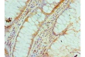 Immunohistochemistry of paraffin-embedded human colon cancer using ABIN7142923 at dilution of 1:100 (MUTYH antibody  (AA 1-265))