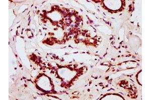 IHC image of ABIN7145662 diluted at 1:200 and staining in paraffin-embedded human breast cancer performed on a Leica BondTM system. (BOLA2 antibody  (AA 1-86))