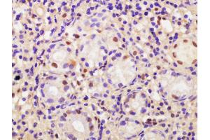 Formalin-fixed and paraffin embedded human gastric carcinoma labeled with Anti-CDCA2 Polyclonal Antibody, Unconjugated  at 1:200 followed by conjugation to the secondary antibody and DAB staining (CDCA2 antibody  (AA 361-450))