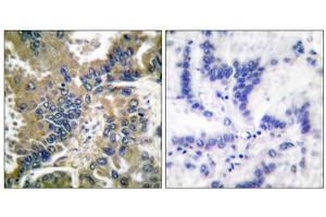 Immunohistochemical analysis of paraffin-embedded human lung carcinoma tissue, using Caspase 1 (Cleaved-Asp210) antibody (ABIN5978453). (Caspase 1 antibody  (Cleaved-Asp210, Internal Region))