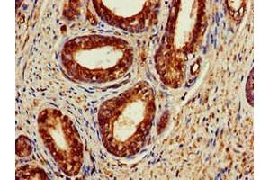 Immunohistochemistry of paraffin-embedded human prostate cancer using ABIN7142946 at dilution of 1:100 (ACAT1 antibody  (AA 76-106))
