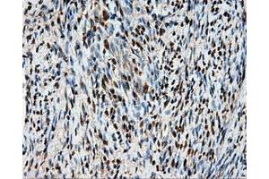 Immunohistochemical staining of paraffin-embedded Adenocarcinoma of ovary tissue using anti-HSPA1A mouse monoclonal antibody. (HSP70 1A antibody)