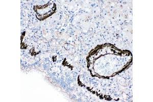 IHC-P: FABP6 antibody testing of human lung cancer tissue