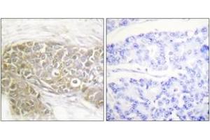 Immunohistochemistry analysis of paraffin-embedded human breast carcinoma tissue, using PEA-15 (Ab-116) Antibody.