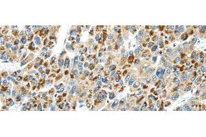 Immunohistochemistry of paraffin-embedded Human liver cancer tissue using THBS2 Polyclonal Antibody at dilution 1:30 (Thrombospondin 2 antibody)