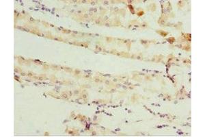 Immunohistochemistry of paraffin-embedded human gastric cancer using ABIN7158947 at dilution of 1:100 (GSTZ1 antibody  (AA 1-216))