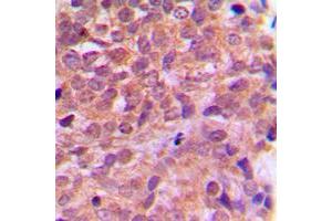Immunohistochemical analysis of AMPK beta 1 staining in human breast cancer formalin fixed paraffin embedded tissue section. (PRKAB1 antibody  (N-Term))