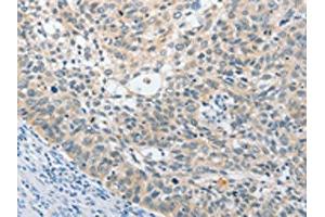 The image on the left is immunohistochemistry of paraffin-embedded Human cervical cancer tissue using ABIN7131538(UCHL5 Antibody) at dilution 1/25, on the right is treated with fusion protein. (UCHL5 antibody)