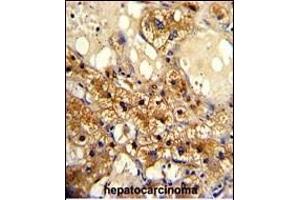 Formalin-fixed and paraffin-embedded human hepatocarcinoma with CYP20A1 Antibody (C-term), which was peroxidase-conjugated to the secondary antibody, followed by DAB staining. (CYP20A1 antibody  (C-Term))