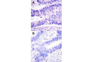 Immunohistochemical staining (Formalin-fixed paraffin-embedded sections) of human colon carcinoma tissue with WASF1 (phospho Y125) polyclonal antibody  under 1:50-1:100 dilution (A) or treated with synthesized peptide (B). (WASF1 antibody  (pTyr125))