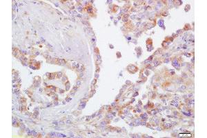 Formalin-fixed and paraffin embedded human lung carcinoma  labeled with Rabbit Anti-CD44 Polyclonal Antibody (ABIN669591) at 1:200 followed by conjugation to the secondary antibody and DAB staining (CD44 antibody  (AA 701-742))