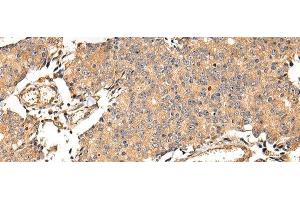 Immunohistochemistry of paraffin-embedded Human prostate cancer using ALDH3A2 Polyclonal Antibody at dilution of 1/20 (ALDH3A2 antibody)