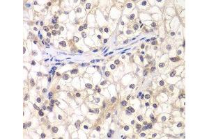 Immunohistochemistry of paraffin-embedded Human kidney cancer using USF1 Polyclonal Antibody at dilution of 1:200 (40x lens). (USF1 antibody)