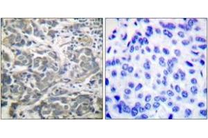 Immunohistochemistry analysis of paraffin-embedded human breast carcinoma tissue, using AMPK alpha (Ab-172) Antibody. (AMPK alpha antibody  (AA 140-189))