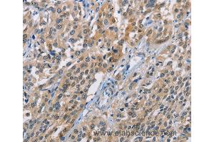 Immunohistochemistry of Human esophagus cancer using CBR1 Polyclonal Antibody at dilution of 1:40