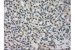 Immunohistochemical staining of paraffin-embedded Adenocarcinoma of colon tissue using anti-TRIB2mouse monoclonal antibody. (TRIB2 antibody)