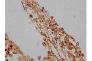 IHC image of ABIN7157890 diluted at 1:100 and staining in paraffin-embedded human melanoma cancer performed on a Leica BondTM system. (LAMb4 antibody  (AA 1513-1761))