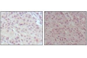 Immunohistochemical analysis of paraffin-embedded human lung cancer (left) and esophagus cancer (right), showing nuclear weak staining with DAB staining using MLL antibody.