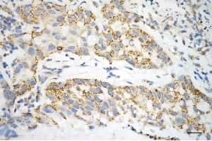 Immunohistochemistry was performed on paraffin-embedded human hepatocarcinoma using ACAT1 antibody (ABIN7797438), 1:200). (ACAT1 antibody)