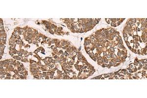 Immunohistochemistry of paraffin-embedded Human esophagus cancer tissue using CAD Polyclonal Antibody at dilution of 1:50(x200) (CAD antibody)