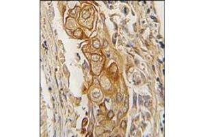 Formalin-fixed and paraffin-embedded human lung carcinoma tissue reacted with ACPP antibody (C-term), which was peroxidase-conjugated to the secondary antibody, followed by DAB staining.