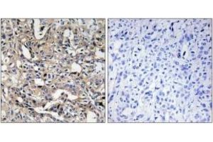 Immunohistochemistry analysis of paraffin-embedded human liver carcinoma, using BAX Antibody. (BAX antibody  (AA 10-59))
