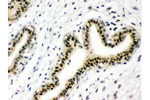 Anti-p95 NBS1 Picoband antibody, IHC(P) IHC(P): Human Mammary Cancer Tissue (Nibrin antibody  (C-Term))