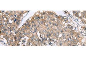 Immunohistochemistry of paraffin-embedded Human liver cancer tissue using RPL18 Polyclonal Antibody at dilution of 1:70(x200) (RPL18 antibody)