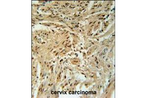 BLOC1S2 Antibody immunohistochemistry analysis in formalin fixed and paraffin embedded human cervix carcinoma followed by peroxidase conjugation of the secondary antibody and DAB staining.