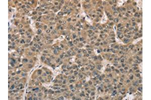 The image on the left is immunohistochemistry of paraffin-embedded Human liver cancer tissue using ABIN7129149(DACH2 Antibody) at dilution 1/40, on the right is treated with fusion protein.