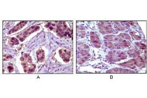 Immunohistochemical analysis of paraffin-embedded human breast carcinoma (A) and liver carcinoma (B), showing cytoplasmic localization using BCL10 antibody with DAB staining. (BCL10 antibody)