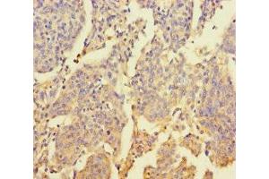 Immunohistochemistry of paraffin-embedded human cervical cancer using ABIN7176469 at dilution of 1:100 (ZNF662 antibody  (AA 182-452))