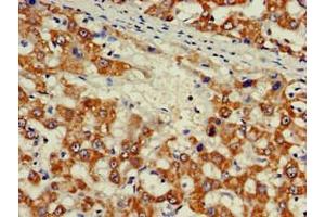 Immunohistochemistry of paraffin-embedded human liver cancer using ABIN7176539 at dilution of 1:100 (Zinc Finger Protein 816A (ZNF816A) (AA 1-200) antibody)