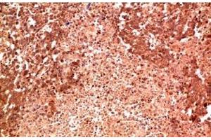 Immunohistochemistry of paraffin-embedded Human lung carcinoma tissue using P38 Monoclonal Antibody at dilution of 1:200. (MAPK14 antibody)