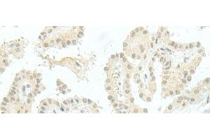 Immunohistochemistry of paraffin-embedded Human thyroid cancer tissue using ESRP2 Polyclonal Antibody at dilution of 1:95(x200) (ESRP2 antibody)