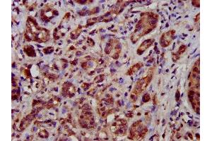IHC image of ABIN7149946 diluted at 1:500 and staining in paraffin-embedded human pancreatic cancer performed on a Leica BondTM system. (TFB1M antibody  (AA 59-194))