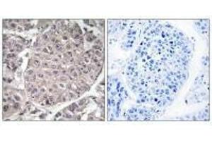 Immunohistochemistry analysis of paraffin-embedded human liver carcinoma tissue using APOL4 antibody.