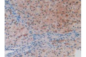 IHC-P analysis of Human Liver Cancer Tissue, with DAB staining. (BACE2 antibody  (AA 230-396))