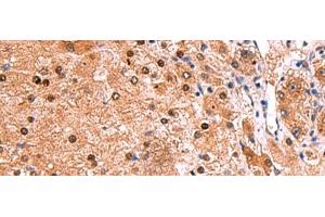 Immunohistochemistry of paraffin-embedded Human liver cancer tissue using TSEN2 Polyclonal Antibody at dilution of 1:80(x200) (TSEN2 antibody)