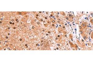 Immunohistochemistry of paraffin-embedded Human liver cancer tissue using TSEN2 Polyclonal Antibody at dilution of 1:80(x200)