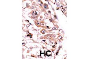 Formalin-fixed and paraffin-embedded human hepatocellular carcinoma tissue reacted with PPP3CC polyclonal antibody  , which was peroxidase-conjugated to the secondary antibody, followed by AEC staining. (PPP3CC antibody  (C-Term))