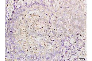 Formalin-fixed and paraffin embedded human esophageal carcinoma labeled with Anti-ROCK1 Polyclonal Antibody, Unconjugated (ABIN738636) at 1:200 followed by conjugation to the secondary antibody and DAB staining. (ROCK1 antibody  (AA 1001-1200))