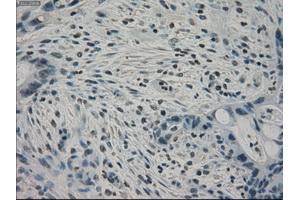 Immunohistochemical staining of paraffin-embedded Carcinoma of pancreas tissue using anti-PPP1R7mouse monoclonal antibody. (PPP1R7 antibody)