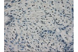 Immunohistochemical staining of paraffin-embedded Carcinoma of pancreas tissue using anti-PPP1R7mouse monoclonal antibody.