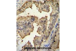 PRMT4 Antibody (Center) immunohistochemistry analysis in formalin fixed and paraffin embedded human prostate carcinoma followed by peroxidase conjugation of the secondary antibody and DAB staining. (CARM1 antibody  (Middle Region))