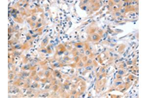 The image on the left is immunohistochemistry of paraffin-embedded Human lung cancer tissue using ABIN7128172(ACOX2 Antibody) at dilution 1/20, on the right is treated with fusion protein. (Acox2 antibody)