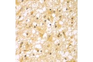 Immunohistochemistry of paraffin-embedded human brain cancer using PAK6 antibody. (PAK6 antibody  (AA 1-270))